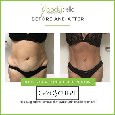 CryoSculpt 45 day before and after of abdomen  and love handles.