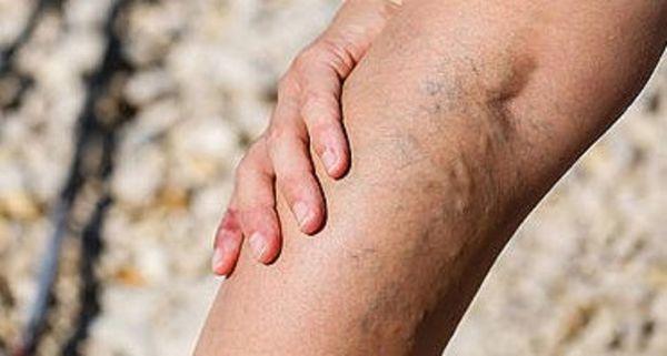 Varicose Vein Treatments Center