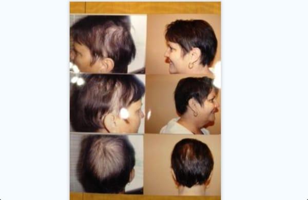 Hair Re-Growth Clinic