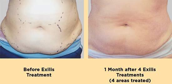 Before and After Exilis Photos