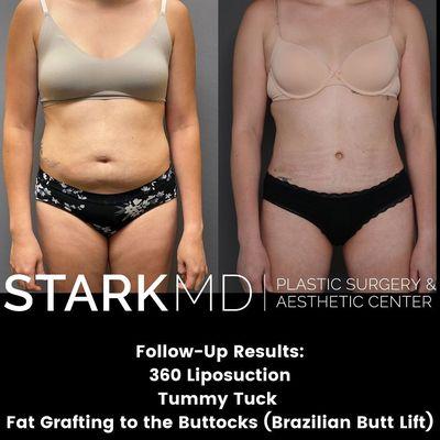 Liposuction Philadelphia