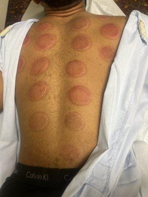 Cupping