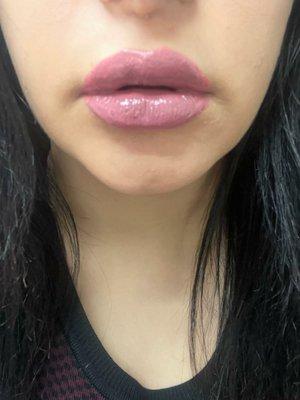 Lip filler