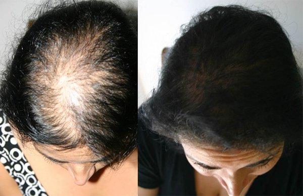 Womens hair loss can be devastating but we have several treatment options that gives natural results