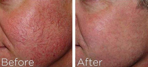 Laser Treatment on Facial Veins