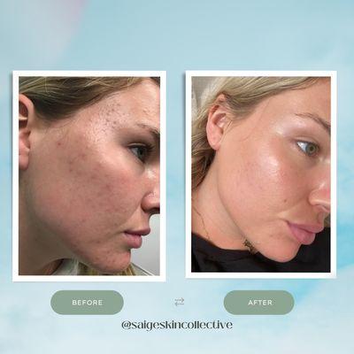 Before and after, skin by Sofia