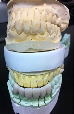 Before and after #6-11 PFM w/ porcelain labial margin.