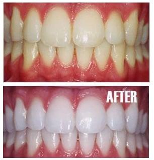 Custom Teeth Whitening Treatment