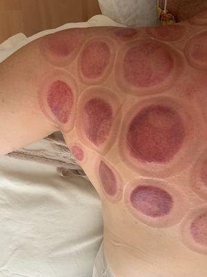 Cupping