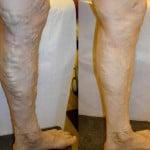 Before and after of varicose vein treatment with Dr. Kabnick