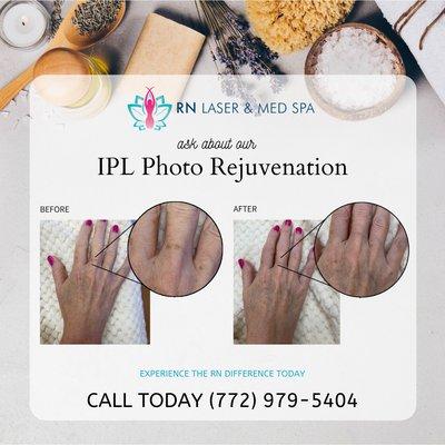 IPL Photo Rejuvenation