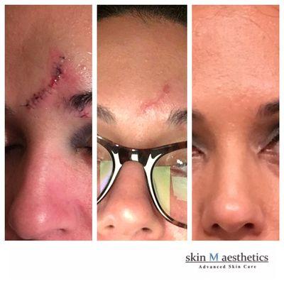 Sublative Rejuvenation scar removal