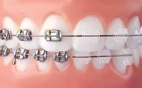 Clear or traditional Braces