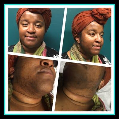 Hyper pigmentation treatment