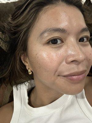 My skin after my facial ‍