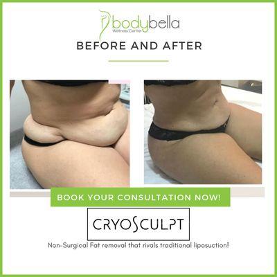 CryoSculpt 45 day before and after of abdomen