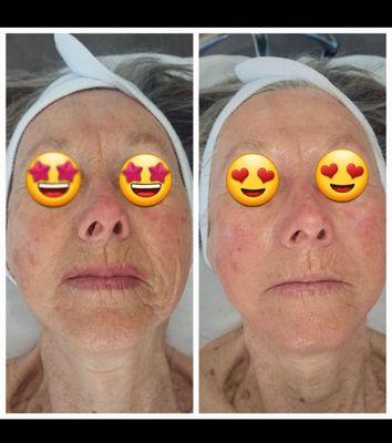 Filler Facial