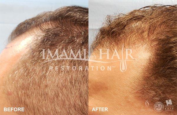 Patient 113040: 38 year old male.  FUE for Hairline reconstruction and fill to Crown with PRP