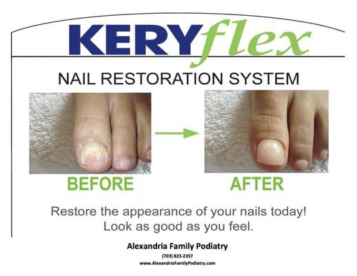 Improve the appearance of your toenail with Keryflex!  A quick, pain-free office visit will give you attractive nails instantly!