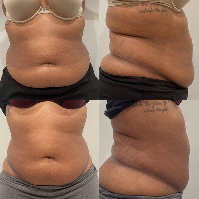 Cavitation/Laser Lipo weight loss Service