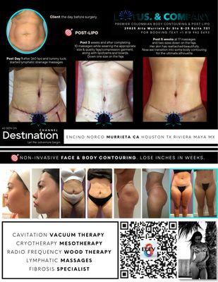 Post Lipo Lymphatic and Body Contouring