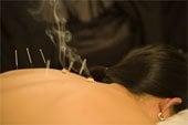 Moxibustion