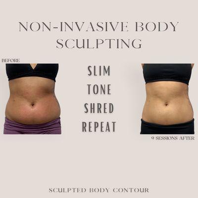 Burn fat permanently with our non-invasive treatment. A safer alternative to Liposuction without the scar and downtime.