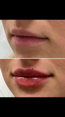 Lip filler