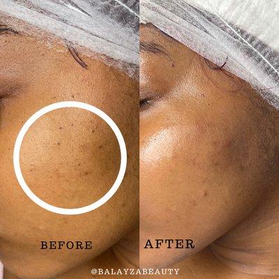 Before an after a Signature Facial, extractions of blackheads