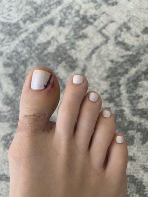 Infected toe the next day after going to Zenisalon