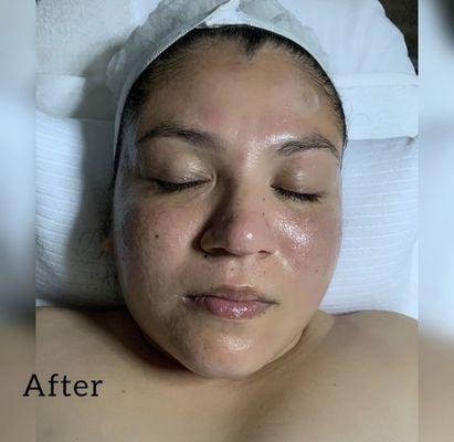 After facial treatment