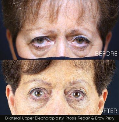 Eyelid surgery and brow lift