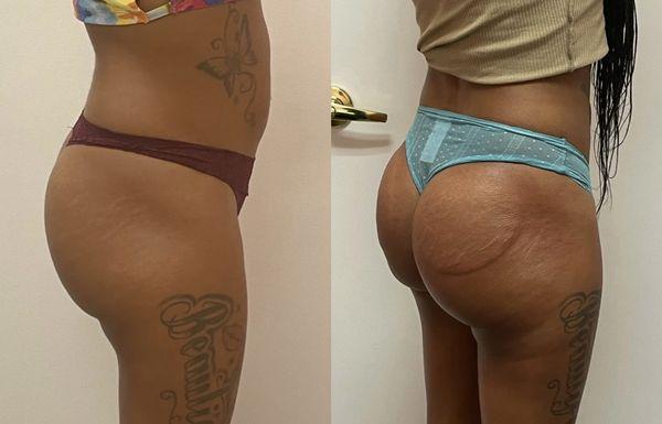 Milan Perfect Peach  Butt Lift after 5 sessions.