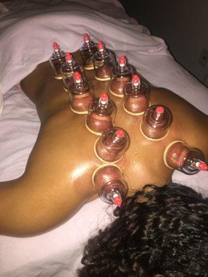 Cupping therapy