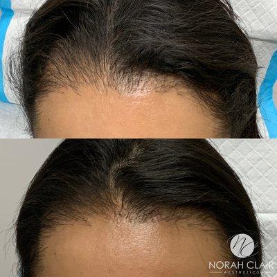 Platelet Rich Plasma (PRP) for hair growth!