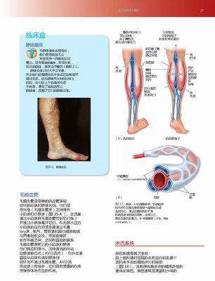 Principle of varicose veins