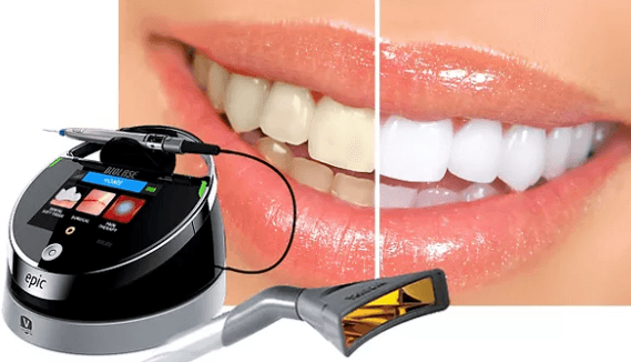 Laser Whitening