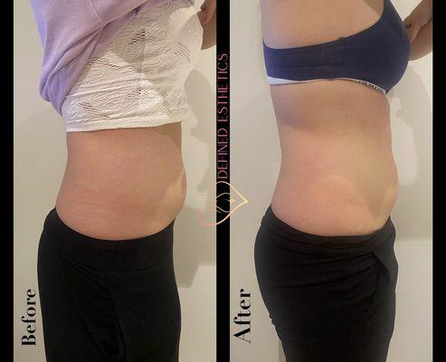 2 sessions of Lipo cavitation treatments