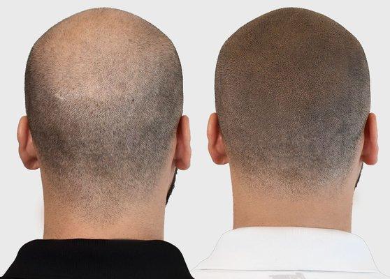 SCALP MICROPIGMENTATION