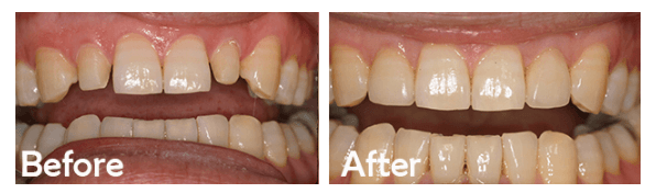 Dental Implants in San Diego