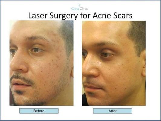 Laser Surgery for Acne Scars