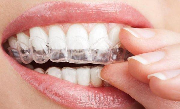 Teeth Whitening