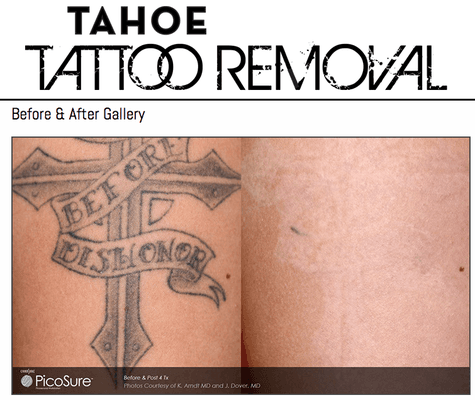 Tahoe Tattoo Removal