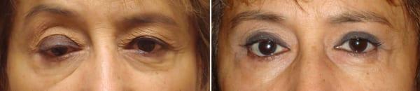 Before and after ptosis repair right upper eyelid and bilateral upper lid blepharoplasty