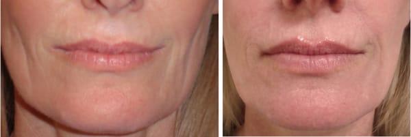 Two months after platelet rich plasma injections to stimulate collagen