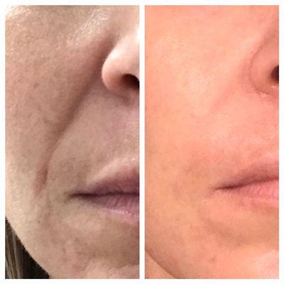 Before/after Juvederm filler to nasolabial fold