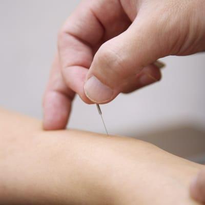 acupuncture