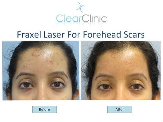 Fraxel Laser for Forehead Scars