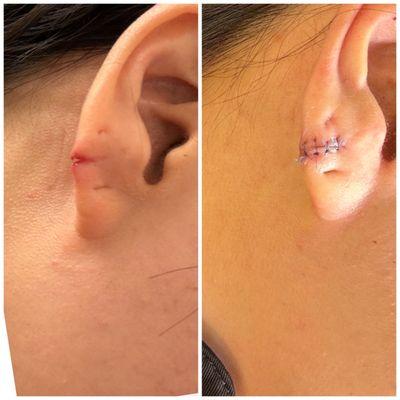 Torn earlobe repair with Dr. Rhoutt!