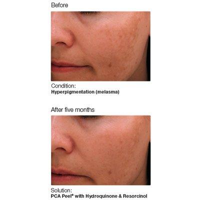 PCA Peels for Visible Aging and Hyperpigmentation